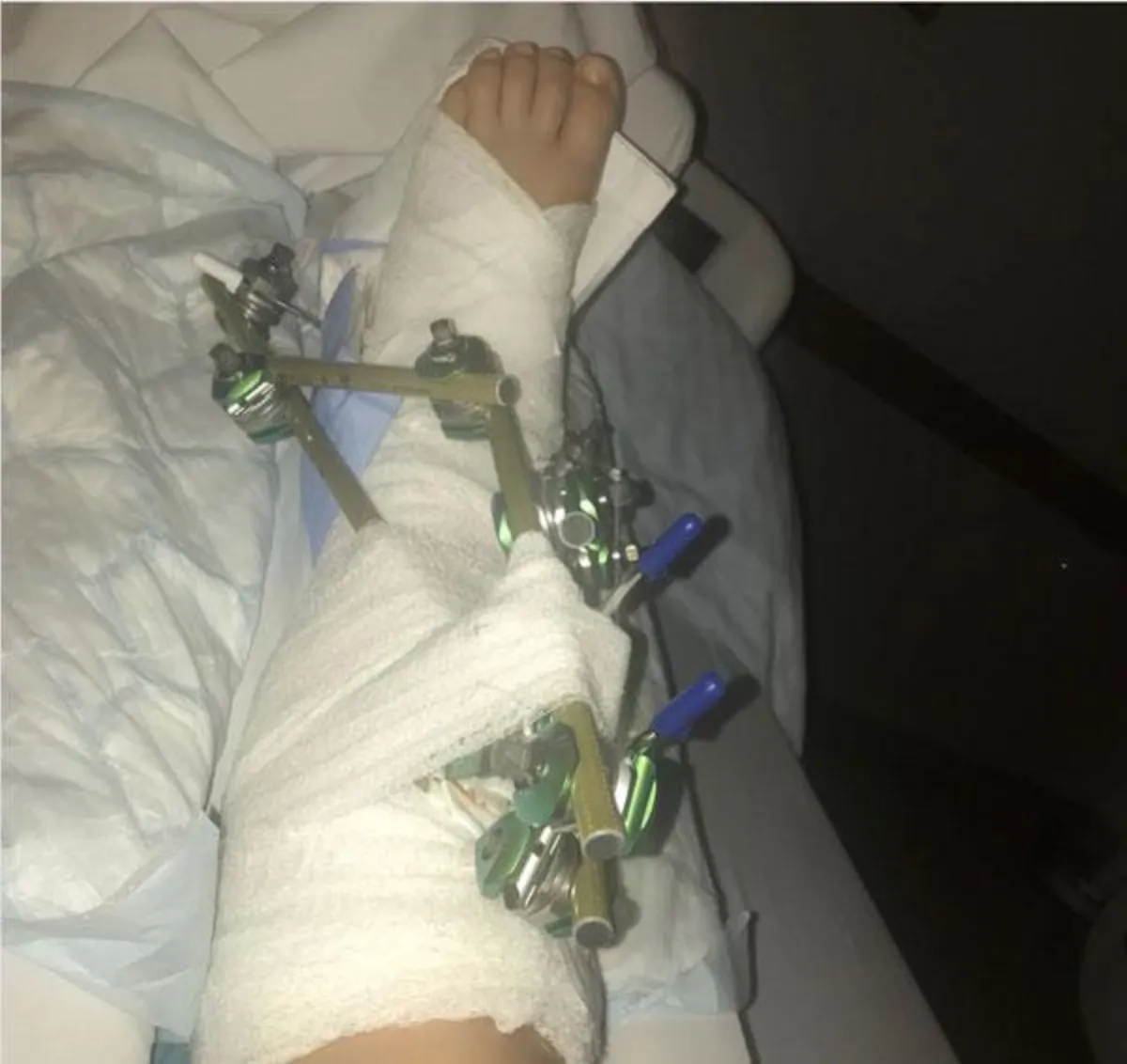 Анастасия Романова получила серьезную травму во время тренировки на горных лыжах